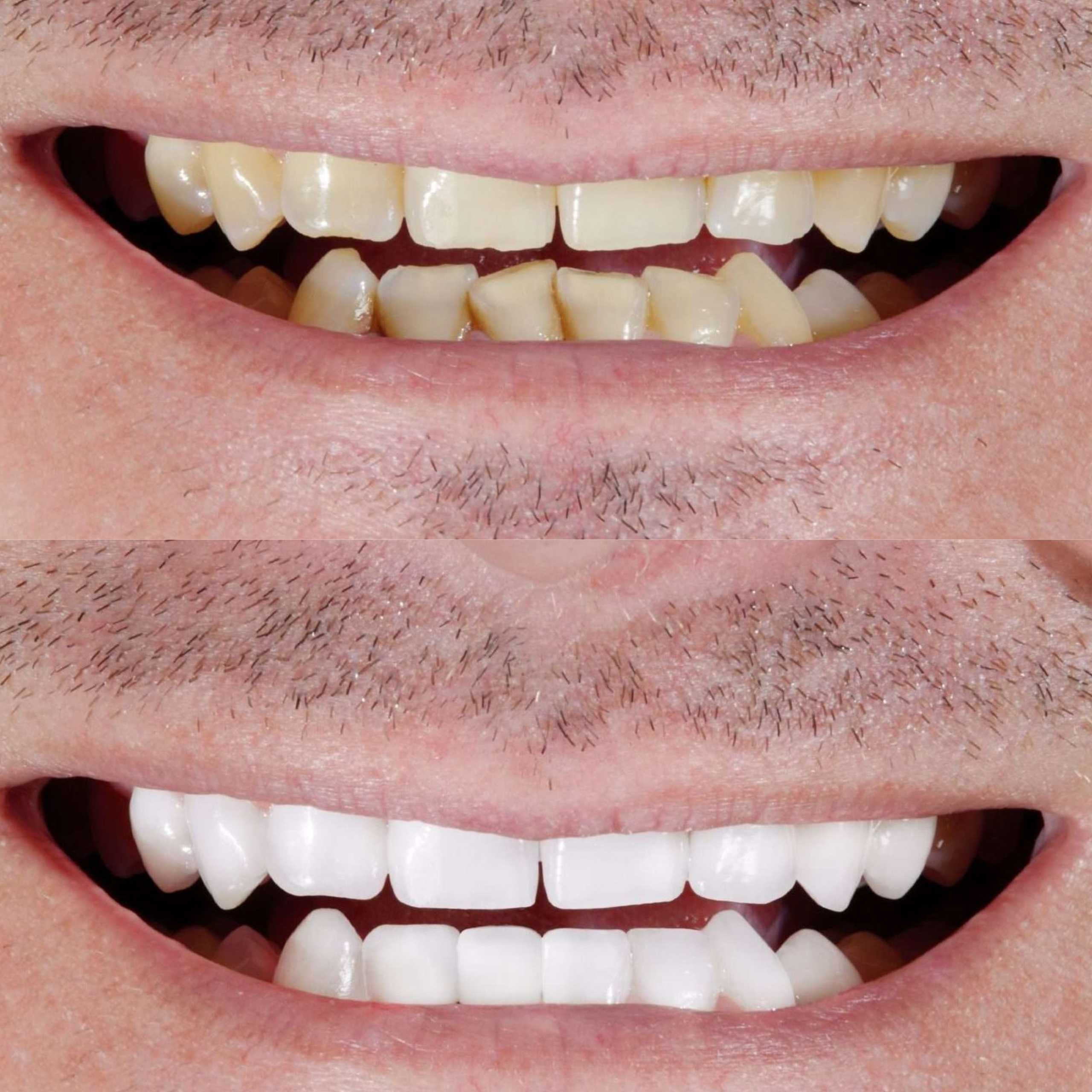 teeth whitening 2