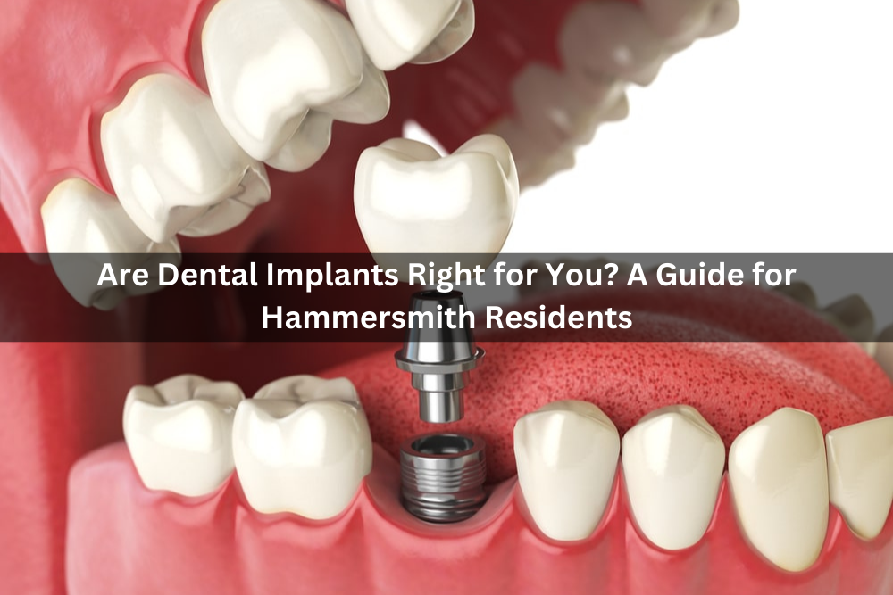 Are Dental Implants Right for You? A Guide for Hammersmith Residents