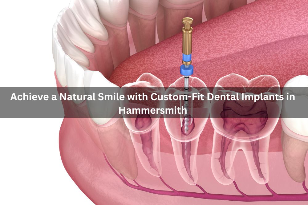Achieve a Natural Smile with Custom-Fit Dental Implants in Hammersmith